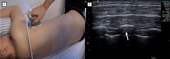 Estabilizadores escapula tempo formacion ecografia 2.jpg